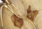 Dolore Testicolare Cronico (Orchite/Orchialgia)