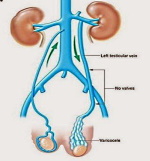 Varicocele